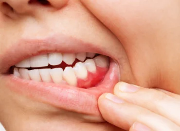 gum disease image
