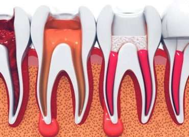 root-canal image